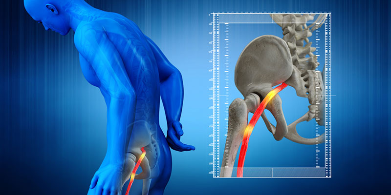 Sciatica: What It is and How to Treat It